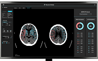 휴런 “뇌졸중 ASPECTS 자동 산출 AI 솔루션 신뢰도 입증”
