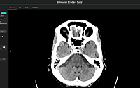 휴런, 응급 뇌졸중 환자 선별 AI 솔루션 혁신 의료기술 지정