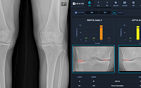 크레스콤, 무릎 관절염 심각도 자동분석 AI 소프트웨어 제조허가
