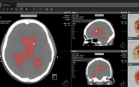 ﻿코어라인소프트, 강북삼성병원에 AI 뇌출혈 진단 솔루션 ‘AVIEW NeuroCAD’ 공급