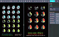 제이엘케이, 뇌 관류 CT영상 분석 솔루션 美 FDA 인허가 신청