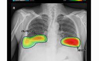 루닛 “AI 결핵 검출 능력 글로벌 12개 제품 중 1위”