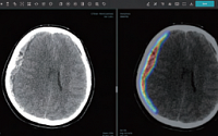 제이엘케이 '美 진출 타깃' 뇌 경막하 출혈 분석 CT 솔루션 JLK-SDH 출시
