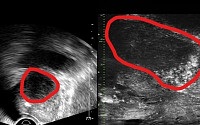 분당서울대병원, 전립선 종양 평가 가능 ‘마이크로 초음파’ 국내 첫 도입