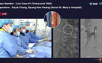 서울성모병원, 국내 첫 경대정맥 대동맥 판막 치환술 실시