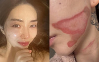 "살이 뜯겨 올라갔다"...AOA 출신 권민아, 시술 후 2도 화상