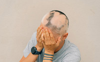 삶 송두리째 흔드는 중증 원형탈모증…치료 접근성 개선 시급