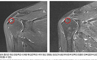 힘찬병원, 회전근개 부분 파열 ‘콜라겐 주입’ 치료 효과 분석
