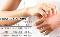 완치 불가능 건선…효과 높고 복약 편한 ‘차세대 신약’ 나올까