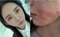 AOA 출신 권민아,  피부 시술 중 화상 피해⋯"합의 제안했다가 협박범으로 몰려"