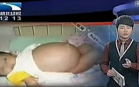 기생태아 중국서 발견...7개월 남아 뱃속에 또 아기가!