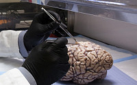 뇌졸중 종류와 원인 &quot;뇌경색 뇌출혈 어떻게 다르죠?&quot;