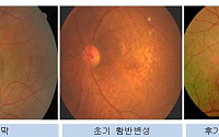 [중장년 희귀·난치 병①] 이휘재도 앓고 있는 '황반변성’  …60세 이상 실명 원인 1위‘ 