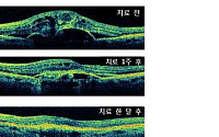 [중장년 희귀·난치 병①]  ‘노년황반변성’  ‘건성노인황반변성’이 환자의 90％