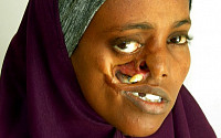 [포토]포탄파편에 맞아 얼굴뼈가 드러난 20대 소말리아 여성