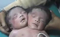 인도서 '머리 둘·몸 공유' 결합 쌍둥이 탄생