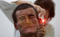 [포토] 희귀 피부병 앓고 있는 브라질 남성