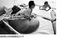 [포토] 배에 100kg 거대 종양을 달고 있는 중국 남성
