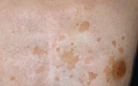 여름철 어루러기 주의보, 알고보니 피부 곰팡이…남성이 두 배 많은 이유는?