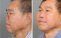 암수술로 코 잃은 중국인, 한국서 재건 성공