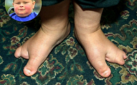 [포토] 발가락이 세개뿐... 영국 4살 아이의 딱한 사연