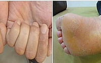 건선이란? 팔꿈치·무릎에 흰 각질 생기면 의심… 20대 전후에 주로 발생