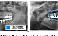 임플란트 '치근 1개당 보철 1개'가 정석