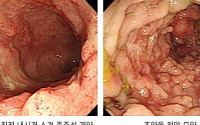 크론병, 그대로 방치했다간 ‘이것’ 걸린다