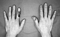 [포토] 장기간 방사선 노출로 괴사된 손가락