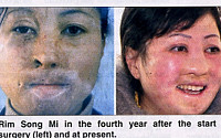 [포토] 얼굴 화상 입은 북한 여성, 성형수술 얼굴 되찾아
