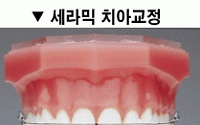 치아 투명교정의 여러가지 치료방법