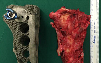3D 프린팅 기술 이용 ‘맞춤형 골반뼈’ 교체 성공