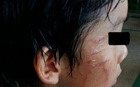 김병지 아들 학교폭력 논란…피해학생 얼굴 상처 봤더니