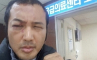 '의리' 김보성, 안와골절에도 수술 포기한 이유… 왼쪽 눈 때문?