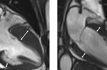 증상도 없는데…‘이 질환’ 돌연사 위험까지 [e건강~쏙]
