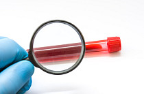 갑자기 찾아오는 ‘급성골수성백혈병’…조기 진단이 관건[e건강~쏙]