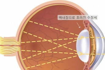 안개가 낀듯 눈앞이 침침… 백내장 ‘나이 상관없다’