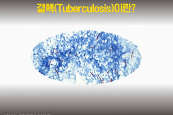 결핵 후진국 대한민국, OECD 발생률 1위 '불명예'