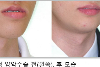 주걱턱 양악 수술 후 재발 가능성 예측 모델 개발