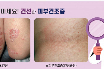 겨울만 되면 가려운 피부…‘건선’일까 ‘피부건조증’일까? [e건강~쏙]