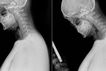 핸드폰 보다가 ‘욱신’…목디스크 예방하려면 [e건강~쏙]