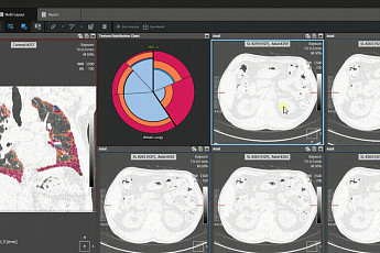 [BioS]코어라인, 베링거에 'AI 폐 영상패턴분석 SW' 공급