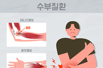 팔꿈치 안팎으로 쑤신다면…테니스·골프엘보 주의 [e건강~쏙]