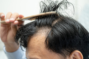 “탈모, 외모 넘어 자존감까지 흔들어…증상 나타났다면 조기 치료해야”[e건강~쏙]