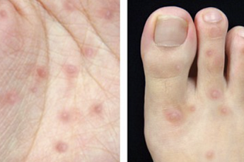 손발·입 속까지 발진…여름 우리 아이 위협하는 ‘이 질환’ [e건강~쏙]