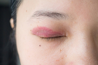 멍들었때 계란 문지르기, 정말 효과 있을까? [에그리씽]