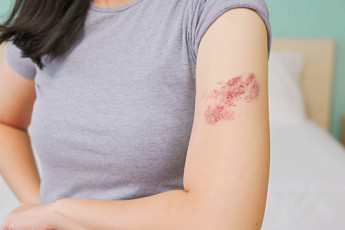 대상포진, 초기 대응이 중요…72시간 내 치료해야 예후 좋아[e건강~쏙]