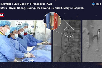 서울성모병원, 국내 첫 경대정맥 대동맥 판막 치환술 실시