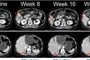 한미약품, 흑색종 항암신약 ‘벨바라페닙’ 임상 2상 첫 환자 투약