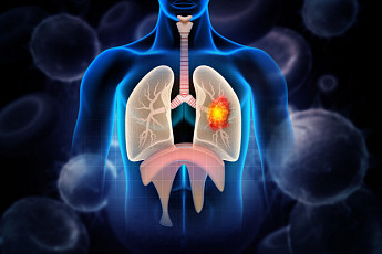 “폐암, 조기 발견이 핵심…수술 후 재발 관리 ‘골든타임’ 중요”